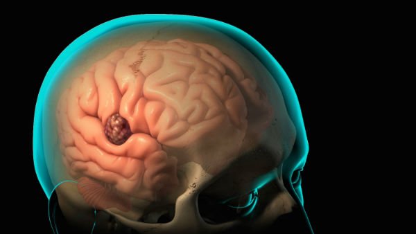 Опухоль головного мозга-виды-причины-симптомы-лечение