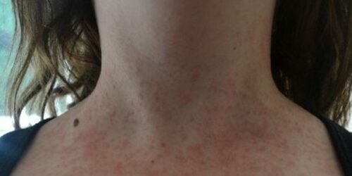 Красные пятна на коже-аллергия